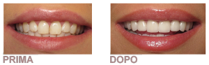 faccette dentali applicazione